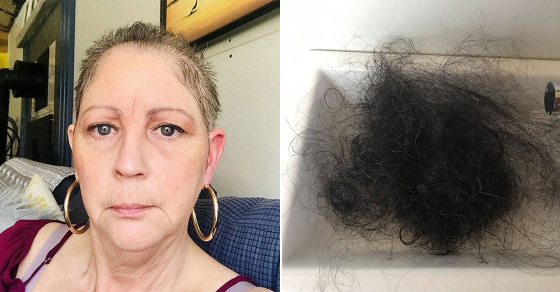 Two-photo collage, one shows Jennifer following chemotherapy treatment and the other shows a sink of hair that's she's lost to-date