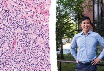 Strain of lymphocytic variant hyper eosinophilic syndrome (L-HES) magnified x20 (left) Dr. Luke Chen, rare disease specialist at the QEII, who made the first diagnosis of L-HES in Atlantic Canada (right). 