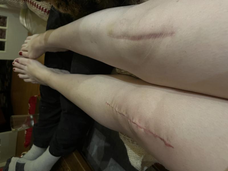 Denise Smith's knees after her second knee replacement surgery at the QEII with the orthopaedic robot.