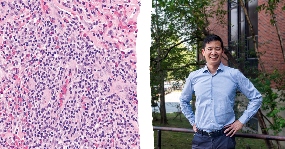 Strain of lymphocytic variant hyper eosinophilic syndrome (L-HES) magnified x20 (left) Dr. Luke Chen, rare disease specialist at the QEII, who made the first diagnosis of L-HES in Atlantic Canada (right). 